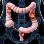 کولورکتال؛ سومین سرطان شایع در اصفهان